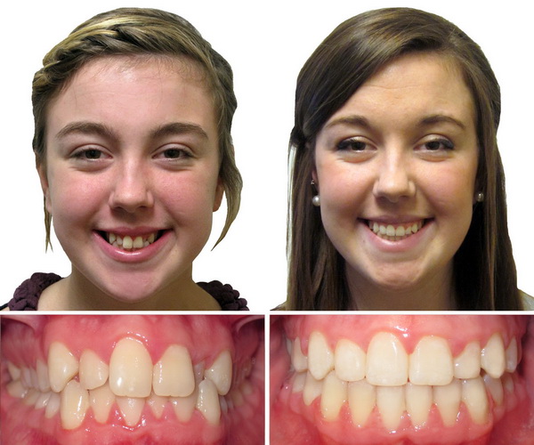 invisalign before and after