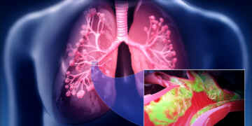 latest lung cancer screening guidelines