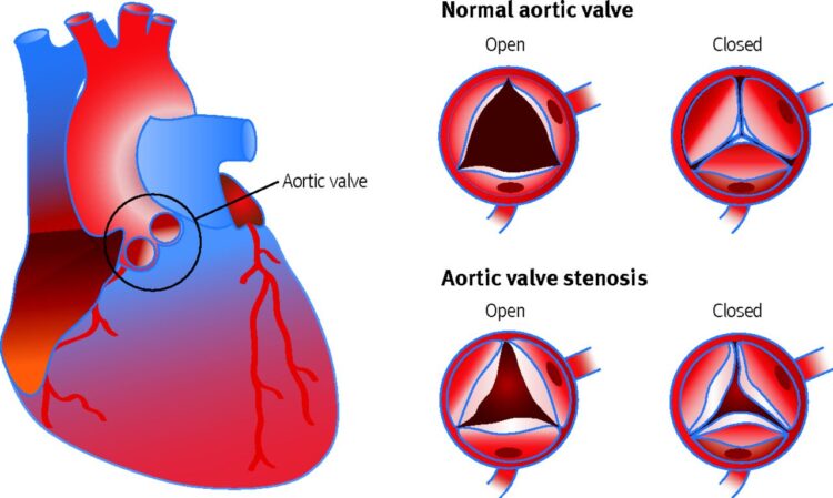 Aortic Valve Stenosis Treatment