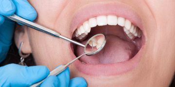 Dentist tools and mouth open with beautiful teeth
